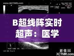 B超线阵实时超声:医学影像技术的革新之路